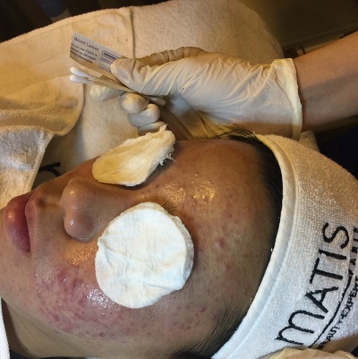 LỢI KHUẨN HỖ TRỢ TRỊ MỤN VIÊM