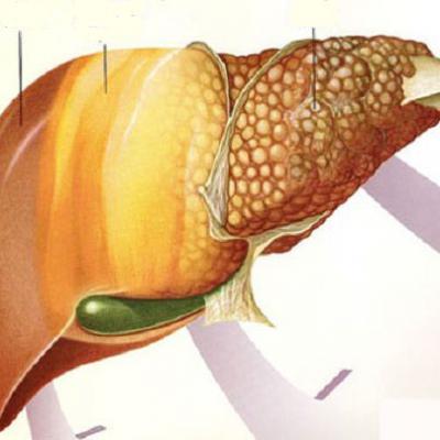 Gan nhiễm mỡ nên và không nên ăn gì