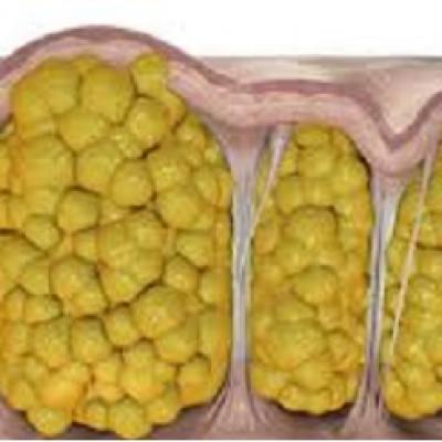 Tích mỡ dưới da ở phụ nữ